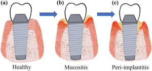 Example of implant animation